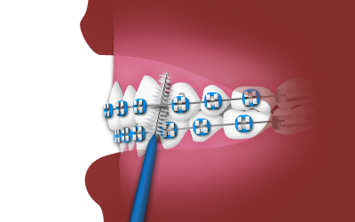 interdental